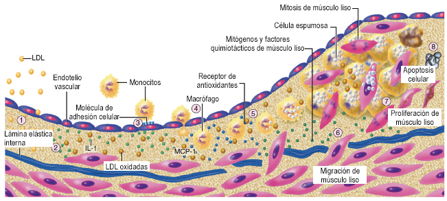 Visión esquemática del proceso de aterosclerosis coronaria.