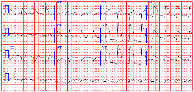 Electrocardiograma que muestra supradesnivel lapidante del segmento ST en un paciente con infarto agudo de miocardio, compatible con SICACEST.