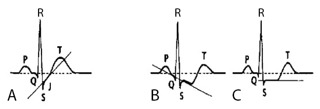 Diagrama esquemático de infradesnivel del ST; en el panel A: infradesnivel ascendente (no sugestivo de isquemia). Paneles B y C: infradesnivel del ST descendente y retificado, ambos sugestivos de isquemia.