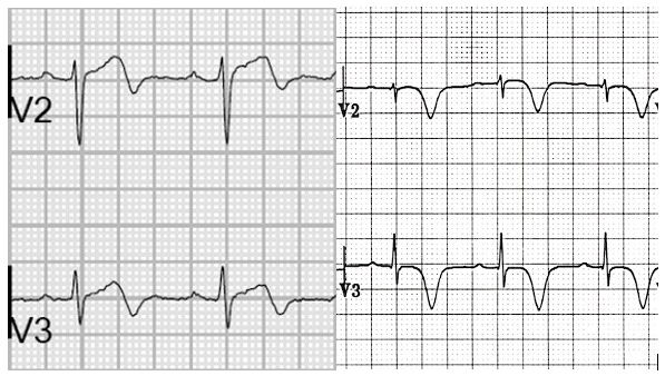 Patrón electrocardiográfico tipo Wellens A y B, ambos sugestivos de enfermedad crítica de la descendente anterior.