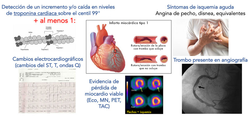 Componentes de la quinta definición de infarto de miocardio.