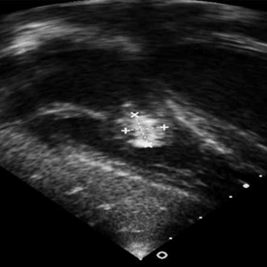 Ecocardiograma transtorácico bidimensional donde se observa imagen de 11 mm de bordes irregulares que corresponde a una vegetación en la inserción de las valvas anterior y septal de la tricúspide que protruye hacia la cavidad ventricular.