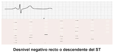 Criterios de interpretación de la prueba de esfuerzo.