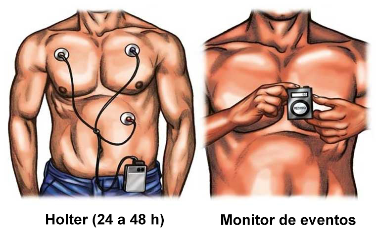 Tipos de Holter ambulatorio