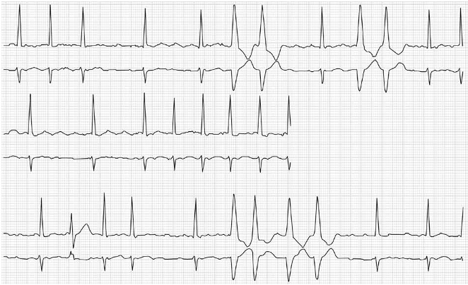 Monitoreo de holter. Fibrilación auricular y latidos con conducción aberrante.