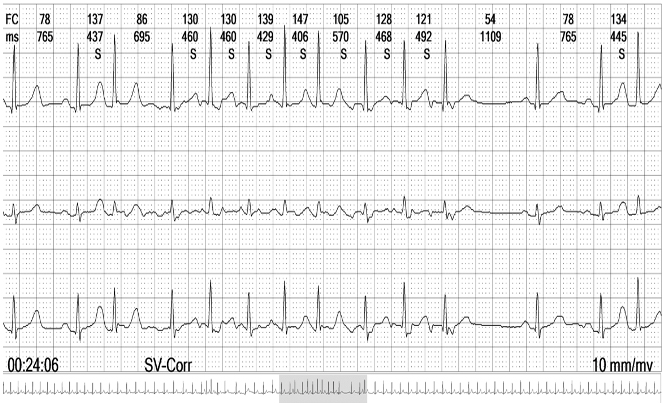 Monitoreo de holter. Fibrilación auricular de corta duración (paroxística).