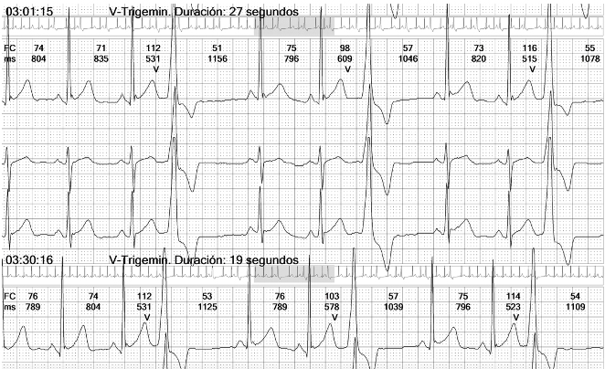 Monitoreo de holter. Monitoreo de holter. Extrasístoles ventriculares frecuentes.