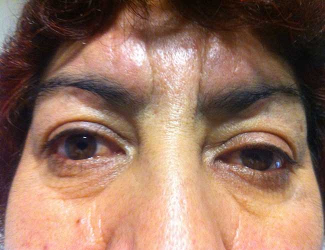 Paciente con síndrome de Horner. Obsérvese la discreta ptosis en el OI.