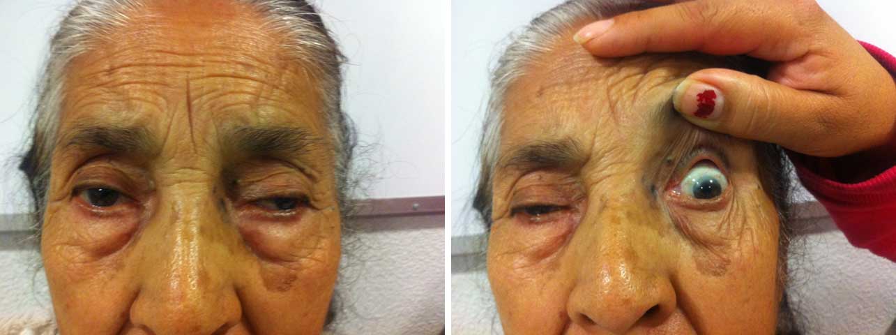 Paciente con miastenia, presenta ptosis palpebral y exodesviacion del ojo izquierdo pero al hacerle la maniobra de la cortina, o sea elevando el párpado superior del OI, en este caso, se aprecia cómo cae el párpado del ojo derecho.