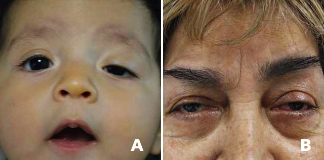 A, El paciente presenta ptosis palpebral congénita severa, trata de compensar la ptosis elevando las cejas y muestra posición compensadora de la cabeza. B, El paciente presenta ptosis aponeurótica involutiva.