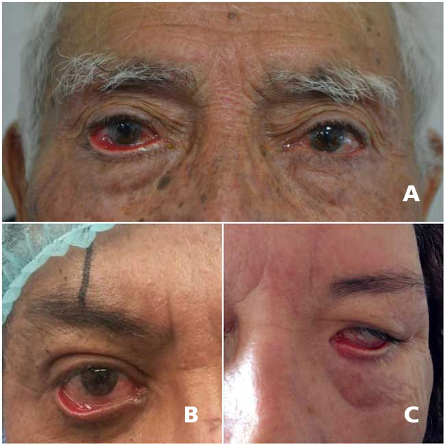 A, Paciente con ectropión tarsal involutivo. B, Paciente con ectropión secundario a blefaroplastia inferior. C, Paciente con ectropión secundario a lesión del VII nervio craneal.