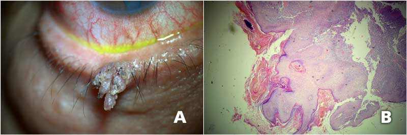 A, Imagen clínica de lesión exofítica, verrugosa, hiperqueratósica compatible con verruga vulgar. B, Se observa un corte histológico que demuestra un epitelio de la dermis hiperqueratósico, engrosado, en forma papiliforme con centros vasculares centrales.