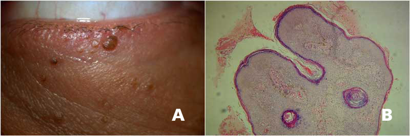 A, Múltiples lesiones en párpado inferior de aspecto grasoso, color café, compatibles con queratosis seborreica. B, Corte histológico que muestra un epitelio engrosado, con acantosis e hiperqueratosis, se observan quistes de queratina típicos de la lesión.