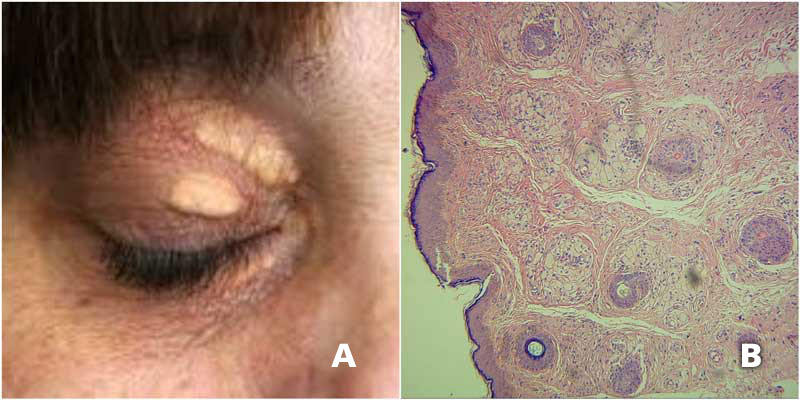 A, Placas amarillentas sobre el párpado superior derecho. B, Corte histológico que demuestra macrófagos espumosos devorando material lipídico.