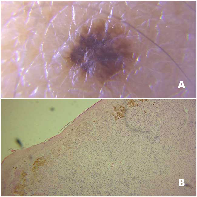 A, Imagen por dermatoscopia de nevo en párpado superior, lesión de color café, distribución de pigmento uniforme y bordes definidos. B, Corte histológico que muestra un conglomerado de células névicas formando nidos por debajo de la membrana basal epitelial, algunas de estas células presentan pigmento de melanina en su citoplasma.