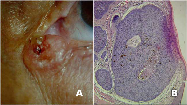 A, Carcinoma basocelular variedad noduloulcerativa en región cantal medial, la lesión se encuentra bien definida, ulcerada, con los bordes sobreelevados y perlados. B, Corte histológico donde se observa una neoplasia compuesta por células basaloides con formación de nidos altamente cohesivos, se observa el característico patrón en empalizada en la periferia de los nidos.