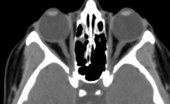 Tomografía axial computada que muestra las estructuras oculares normales.