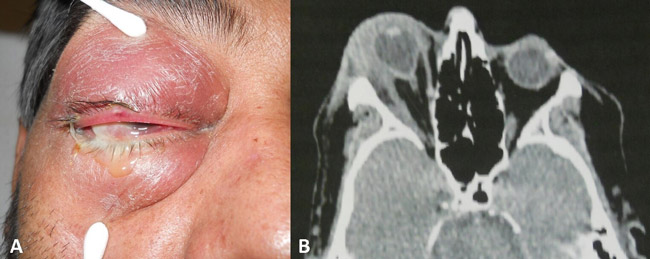  A, Celulitis orbitaria acompañada de edema en hemicara derecha, ptosis, enrojecimiento y edema periocular frontal. B, Tomografía corte axial que muestra proptosis importante y edema de los tejidos blandos perioculares.