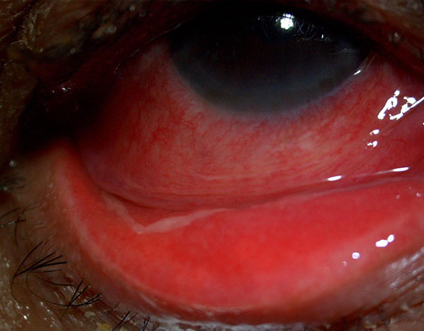 Pseudomembranas inflamatorias en el fondo de saco inferior en una queratoconjuntivitis epidérmica. 