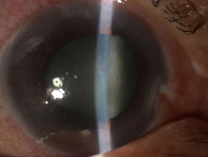 Glaucoma agudo. Edema corneal, pupila en midriasis media. 