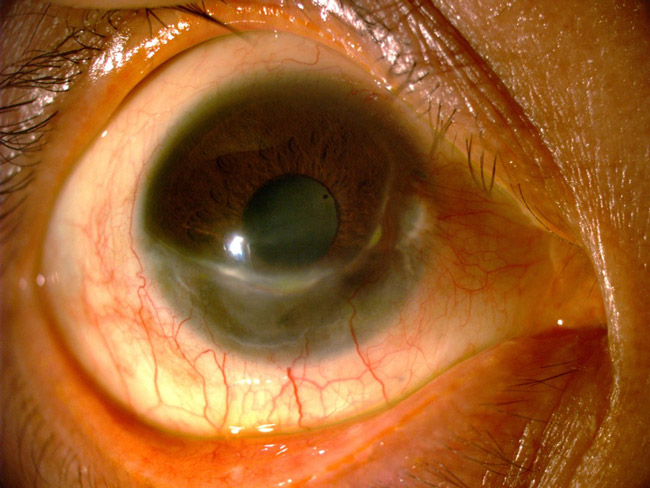 Úlcera corneal periférica. Se observa el adelgazamiento corneal. La invasión de vasos hace ver que se encuentra en estado de cicatrización.