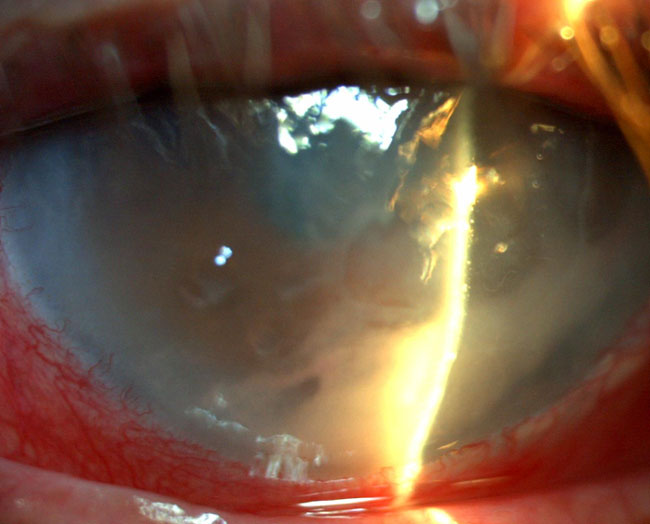 Úlcera con presencia de hipopión, ojo rojo y pérdida de la transparencia corneal a expensas de edema y pérdida del epitelio corneal.