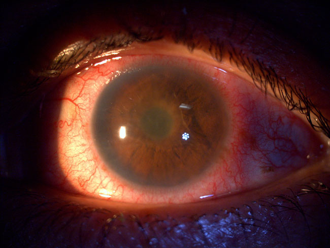 Imagen de uveítis anterior aguda donde es posible observar ojo rojo y fibrina en la cámara anterior.