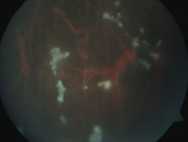 Copos de nieve y vasculitis en retina periférica en un caso de pars planitis.