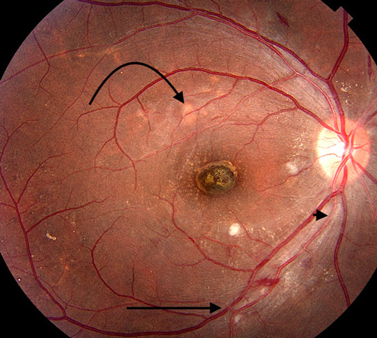 Fotografía clínica de Retinopatía hipertensiva, se pueden observar hemorragias intrarretinianas, cruces AV (flecha negra), infarto de coloides (flecha curva), y adelgazamiento arterial en hilo de cobre (punta de flecha). 