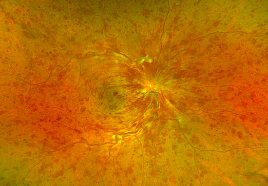 Fotografía de campo amplio de oclusión de vena central de retina, podemos observar hemorragias intrarretinianas y en flama 4 cuadrantes con tortuosidad venosa marcada.