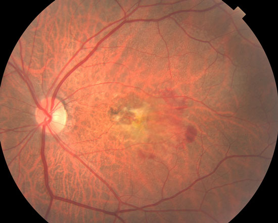 Fotografía clínica de fondo de ojo en un paciente con Degeneración macular relacionada con la edad, variedad húmeda. Podemos observar hemorragia, asociada con una cicatriz disciforme.