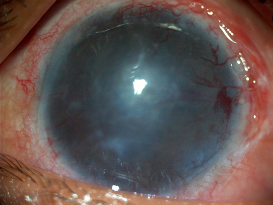 Paciente con quemadura por álcali, se aprecia pérdida de las células limbales con neovascularización superficial de la córnea 360°, pérdida de la transparencia corneal secundaria a la quemadura. 