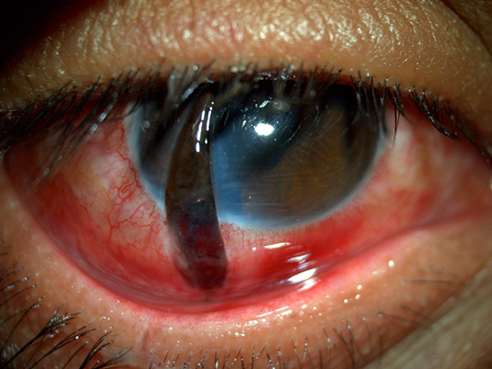 Se aprecia una herida corneo-escleral de espesor total lineal con material uveal autosellando la herida, se observan pliegues a nivel corneal sugerentes de hipotonía. 