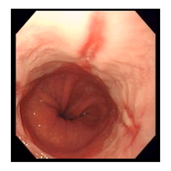Hernia hiatal con esofagitis erosiva.