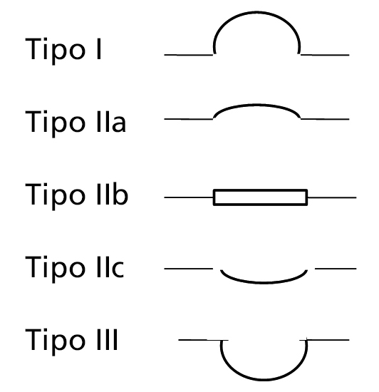 Clasificación de cáncer gástrico incipiente.