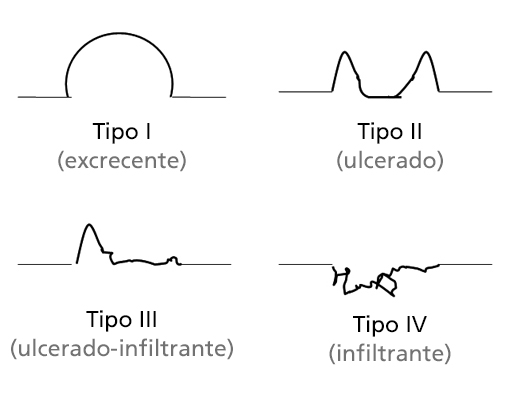 Clasificación del cáncer gástrico avanzado.