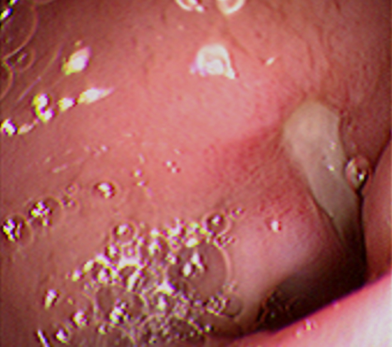 Imagen endoscópica de úlcera duodenal. 