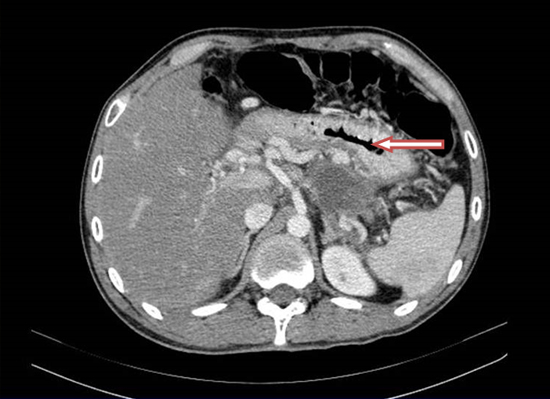 Tomografía computada. Se observa al páncreas aumentado de volumen, con líquido peripancreático. Hay una colección en la cola y aire en conducto pancreático (flecha).