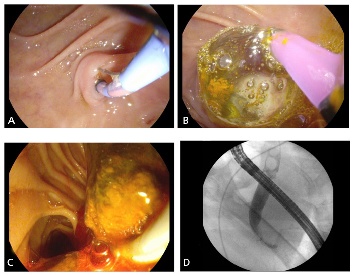 Colangiopancreatografía retrógrada endoscópica (CPRE). A, Canulación y esfintorotomía. B, Barrido con balón. C, Lito en luz duodenal. D, Fluoroscopia que muestra dilatación de colédoco y litos en su interior.